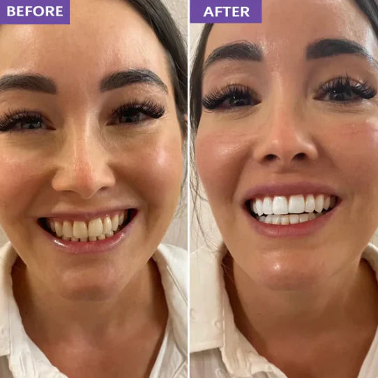 Neol Purple Teeth Whitening Strips™